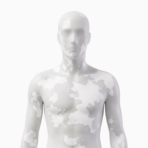 Vitiligo